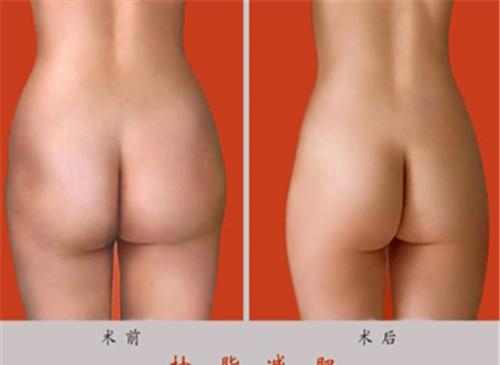 哪些方式瘦臀部最好瘦臀部吸脂术好在什么地方？