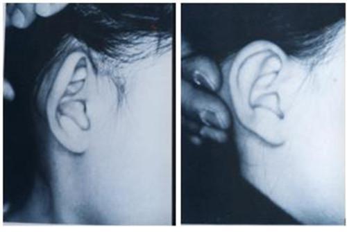 耳朵畸形的修复术